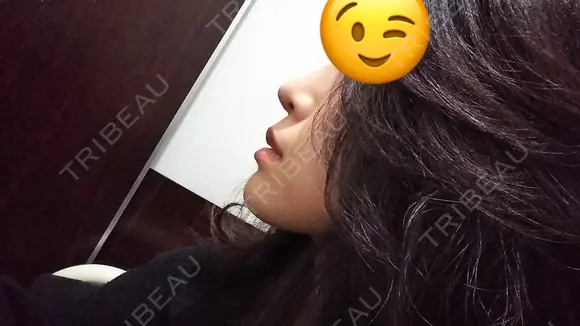 鼻尖形成（切開） / 軟骨移植 表参道スキンクリニック 表参道院 DAY 26 メイン用