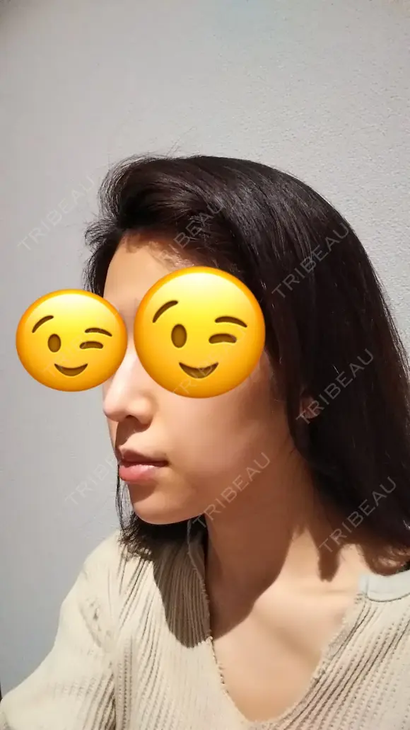 鼻尖形成（切開） / 軟骨移植 表参道スキンクリニック 表参道院 DAY 87 メイン用