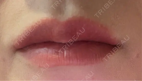 アートメイク（唇） セカジソウォン医院-明洞店 DAY 8 メイン用