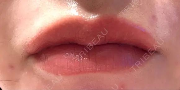 アートメイク（唇） セカジソウォン医院-明洞店 DAY 8 メイン用