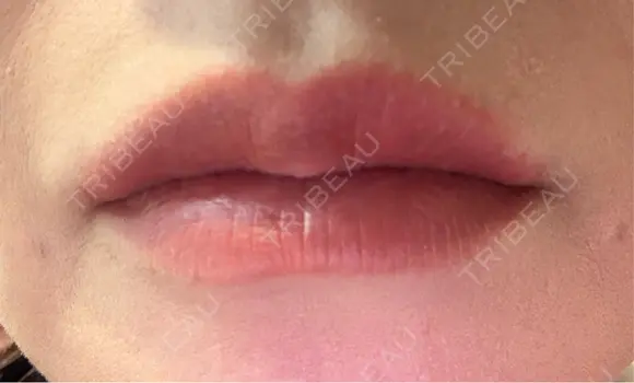 アートメイク（唇） セカジソウォン医院-明洞店 DAY 7 メイン用