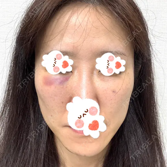 肌ヒアルロン酸注入（たるみ・シワ改善） しのぶ皮膚科 DAY 0 メイン用