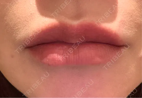 アートメイク（唇） セカジソウォン医院-明洞店 DAY 9 メイン用