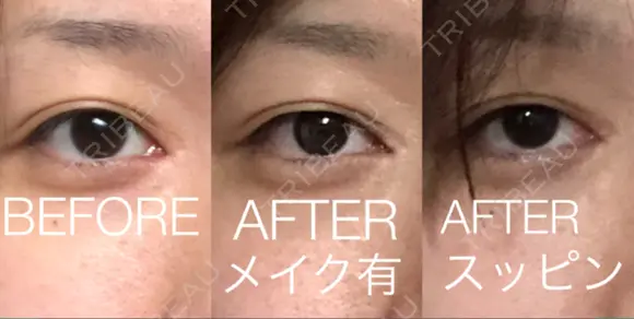 傷跡修正 / ほくろ・いぼ除去レーザー（肌） 山本クリニック AFTER メイン用