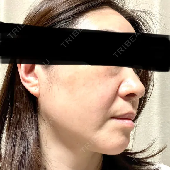 ルメッカ 東京シルククリニック 東京神田院 DAY 15 メイン用