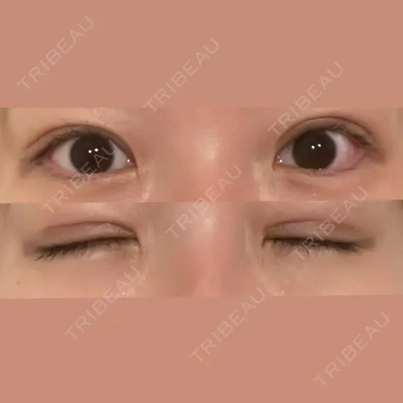 二重切開 / 眼瞼下垂（切開） / 上まぶたたるみ取り eクリニック 福岡院 DAY 21 メイン用