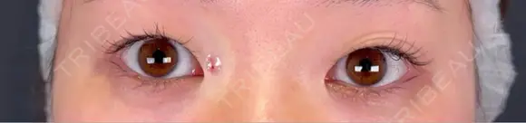 眼瞼下垂（非切開） SOL CLINIC DAY 0 メイン用