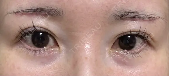 眉下切開 ノエル銀座クリニック DAY 21 メイン用