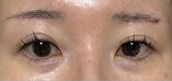 眉下切開 ノエル銀座クリニック DAY 35 メイン用