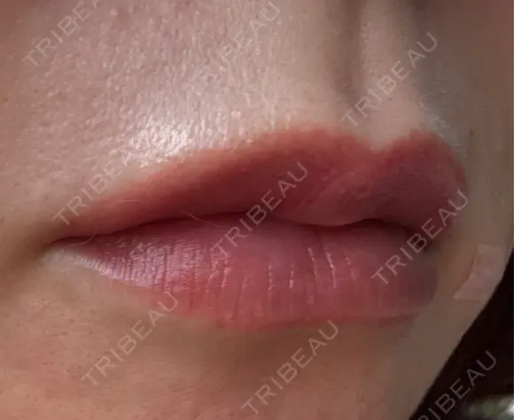 アートメイク（唇） セカジソウォン医院-明洞店 DAY 10 メイン用