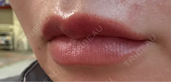 アートメイク（唇） セカジソウォン医院-明洞店 DAY 10 メイン用