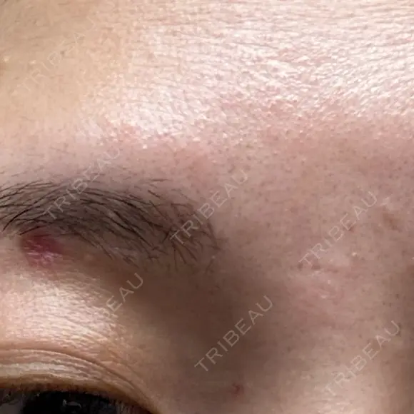 ほくろ・いぼ除去レーザー（肌） Fellez Clinic【フェルズクリニック】 DAY 10 メイン用