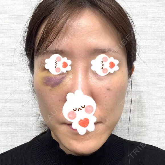 肌ヒアルロン酸注入（たるみ・シワ改善） しのぶ皮膚科 DAY 2 メイン用