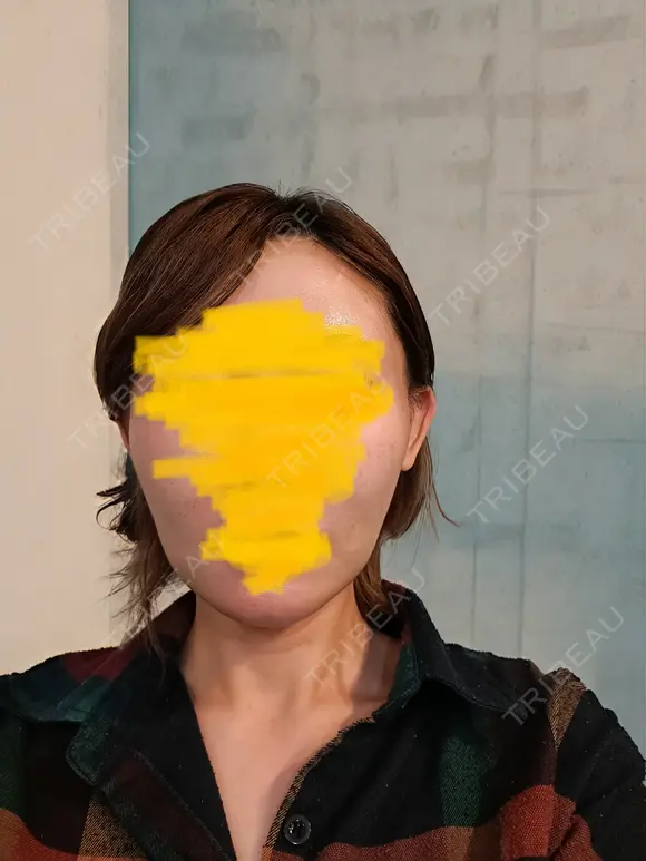 糸リフト / 脂肪吸引（顔） / ジョールファット除去 RIVER CLINIC（リバークリニック） AFTER メイン用