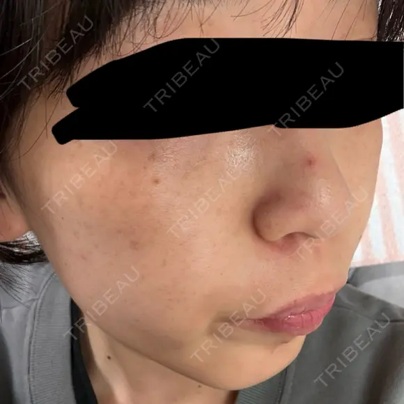 ピーリング（ニキビ・毛穴） / ルメッカ 大美会クリニック 梅田院 DAY 9 メイン用