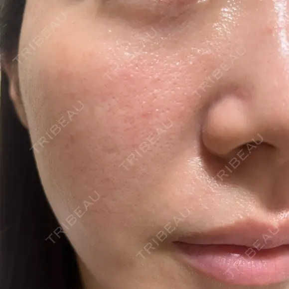 ヴェルヴェットスキン 形成外科と美容外科のクリニック池袋 DAY 2 メイン用