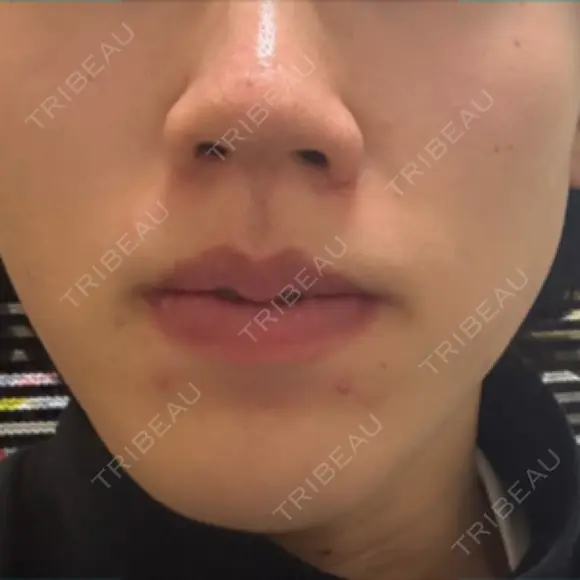 イオン導入 Kinshicho Beauty Clinic （錦糸町ビューティークリニック） DAY 1 メイン用