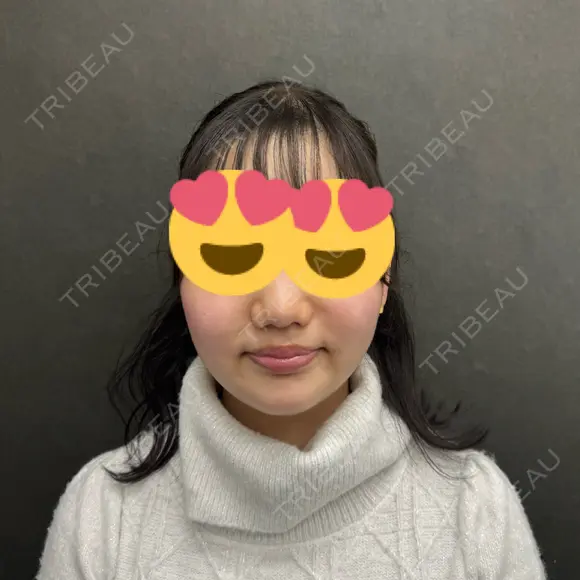 脂肪吸引（顔） ネビュラクリニック 京都院 AFTER メイン用