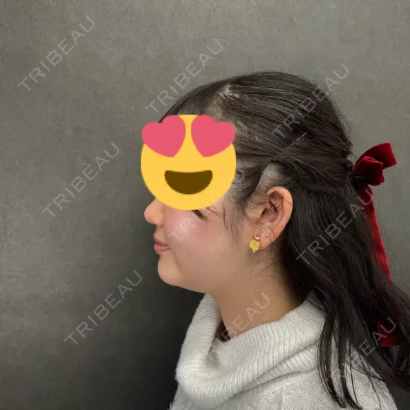 脂肪吸引（顔） ネビュラクリニック 京都院 DAY 0 メイン用