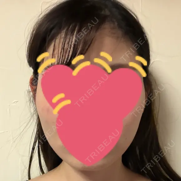 ハイフ（顔） S-Laboクリニック 渋谷院 AFTER メイン用