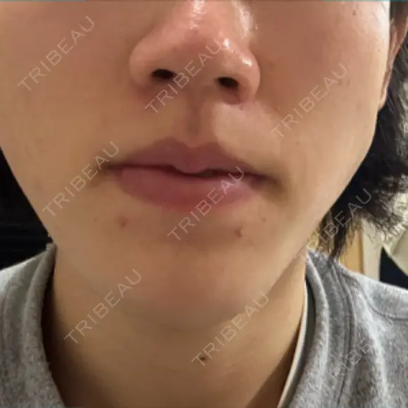 イオン導入 Kinshicho Beauty Clinic （錦糸町ビューティークリニック） DAY 2 メイン用