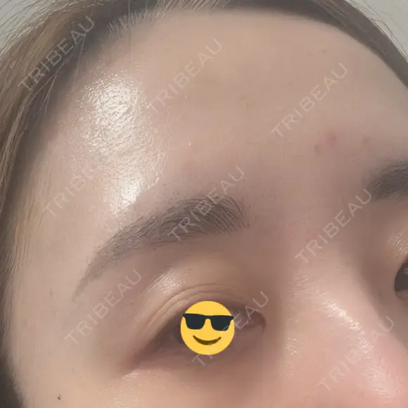 ボトックス（あご） / ボトックス（口角） / ボトックス（眉間） / ボトックス（額） / ボトックス（バニーライン） / その他（鼻） TCB東京中央美容外科 札幌駅前院 DAY 15 メイン用