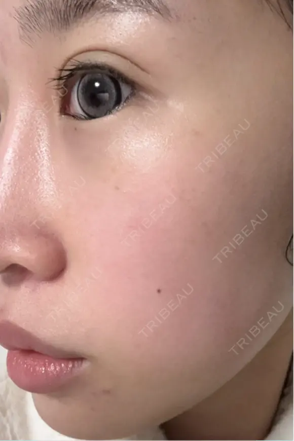 光治療（フォトフェイシャルなど） 眠れるスキンクリニック田町 DAY 0 メイン用