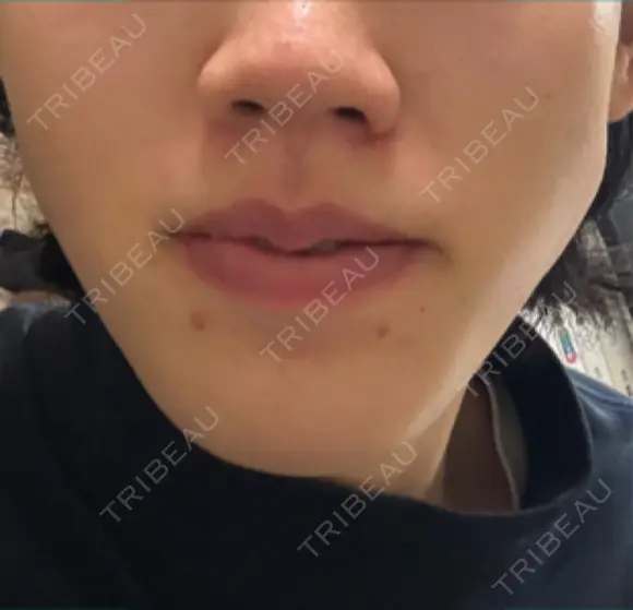 イオン導入 Kinshicho Beauty Clinic （錦糸町ビューティークリニック） DAY 3 メイン用