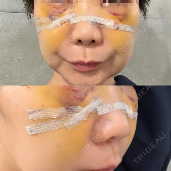クマ治療 池袋麗歯科・美容皮膚科 DAY 5 メイン用
