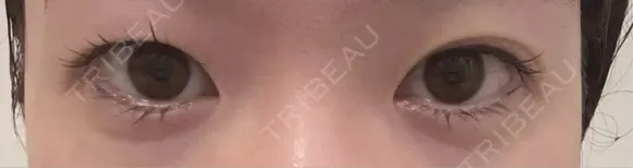 眼瞼下垂（非切開） SOL CLINIC DAY 4 メイン用