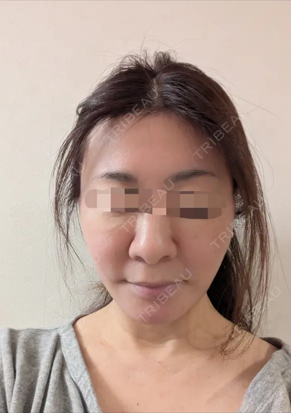 糸リフト / 脂肪吸引（顔） Wing clinic 豊中駅前院 DAY 2 メイン用