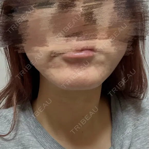 ボトックス（あご） / ボトックス（口角） DMTC CLINIC 渋谷院 AFTER メイン用