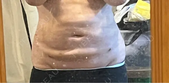 医療痩身（お腹） 渋谷美容外科クリニック 渋谷院 DAY 7 メイン用