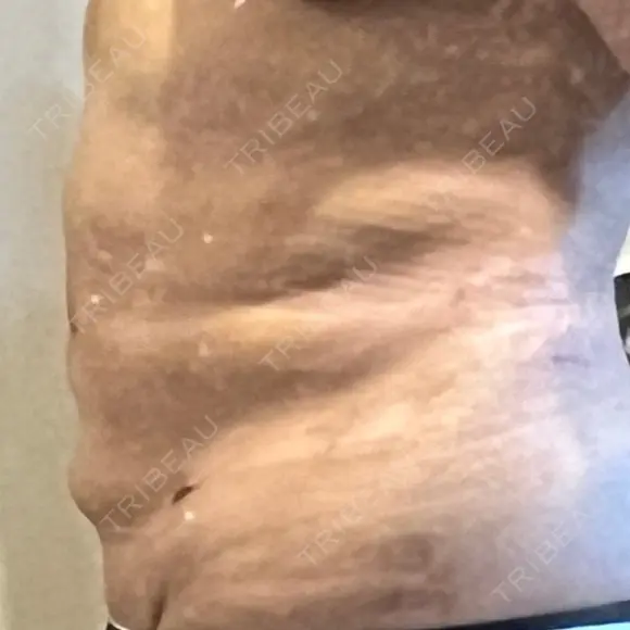 医療痩身（お腹） 渋谷美容外科クリニック 渋谷院 DAY 7 メイン用