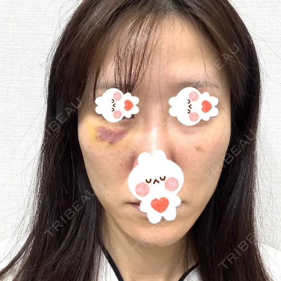 肌ヒアルロン酸注入（たるみ・シワ改善） しのぶ皮膚科 DAY 6 メイン用