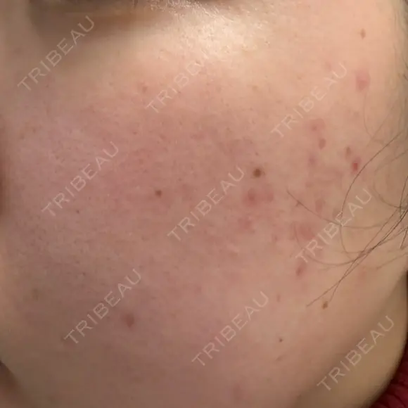 ルメッカ ルラ美容クリニック 郡山院 AFTER メイン用