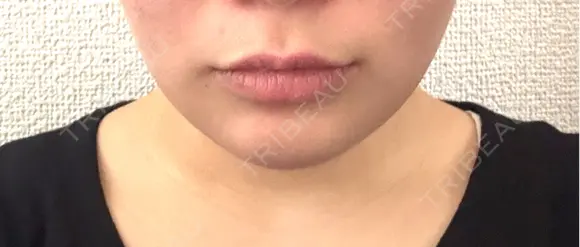 その他（輪郭） Clinic K Blossom DAY 2 メイン用