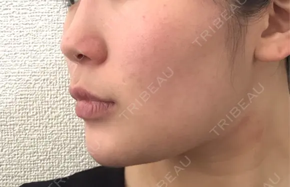 その他（輪郭） Clinic K Blossom DAY 2 メイン用