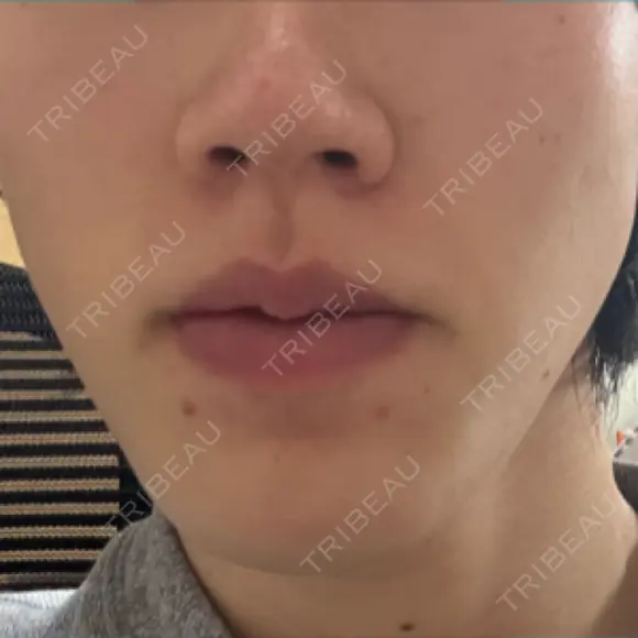 イオン導入 Kinshicho Beauty Clinic （錦糸町ビューティークリニック） DAY 5 メイン用