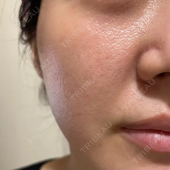 ヴェルヴェットスキン 形成外科と美容外科のクリニック池袋 DAY 6 メイン用