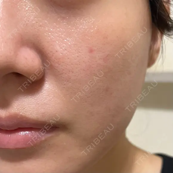 ヴェルヴェットスキン 形成外科と美容外科のクリニック池袋 DAY 6 メイン用