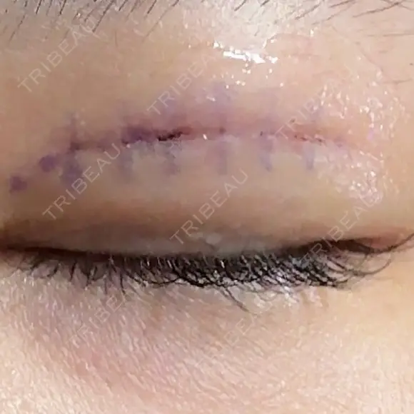 二重埋没 / 自然癒着法 形成外科と美容外科のクリニック池袋 DAY 0 メイン用