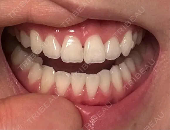 矯正（マウスピース） 湘南歯科クリニック 池袋院 DAY 127 メイン用