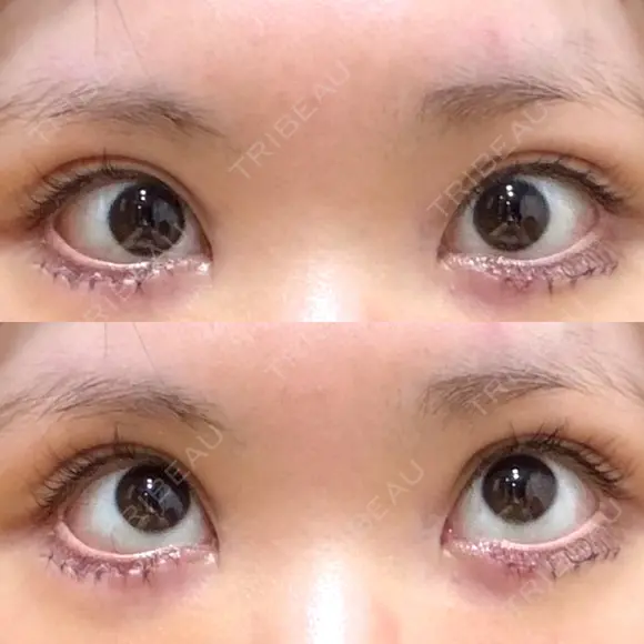 タレ目形成・グラマラスライン（切開） 形成外科と美容外科のクリニック池袋 DAY 7 メイン用