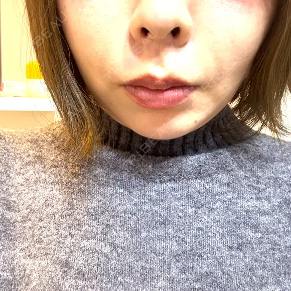糸リフト Days Beauty Clinic 本厚木院 AFTER メイン用