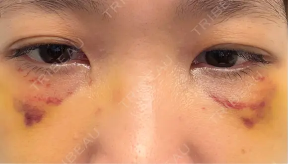 クマ治療 池袋麗歯科・美容皮膚科 DAY 8 メイン用