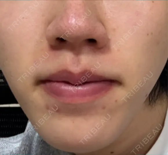 イオン導入 Kinshicho Beauty Clinic （錦糸町ビューティークリニック） DAY 6 メイン用