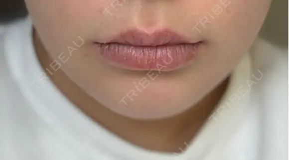 その他（輪郭） Clinic K Blossom DAY 4 メイン用