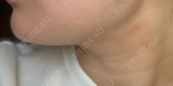 その他（輪郭） Clinic K Blossom DAY 4 メイン用