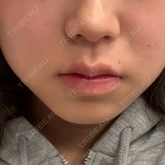 ボトックス（エラ・小顔） BiBiクリニック AFTER メイン用